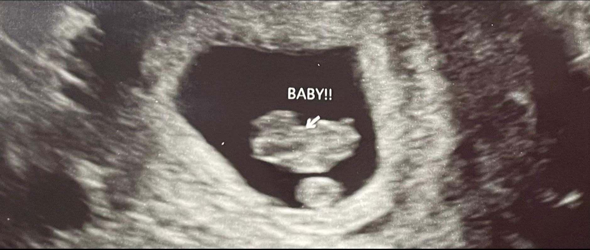 Picture of Janise's baby sonogram